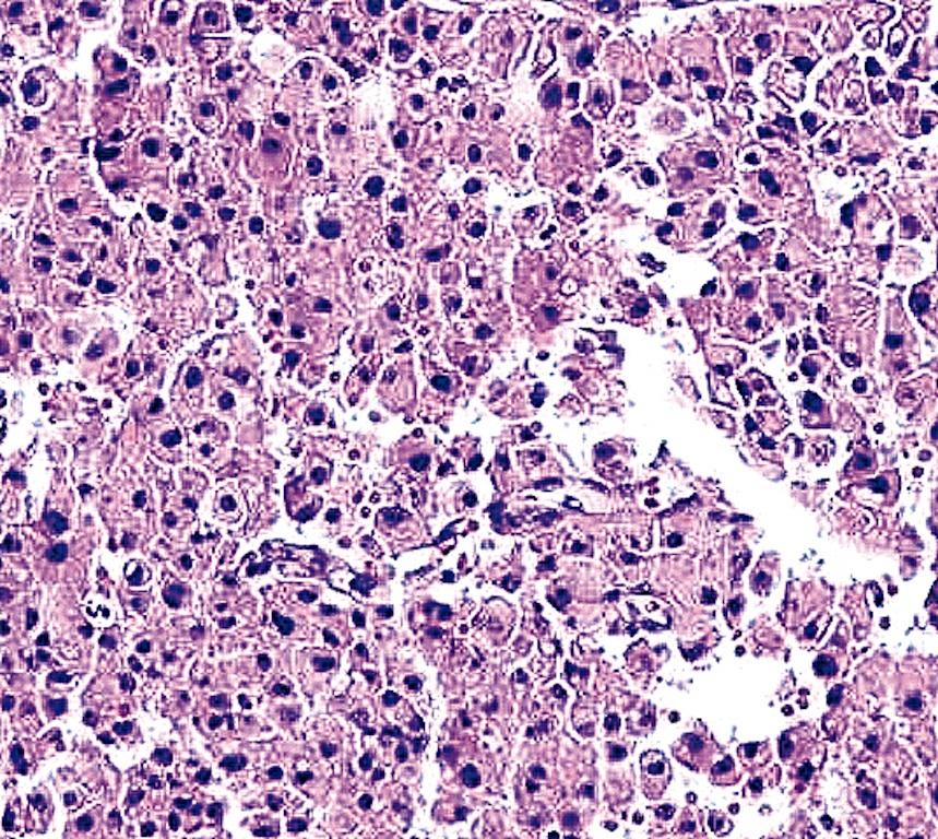 Pathology Outlines Oncocytic (Hürthle cell) tumors